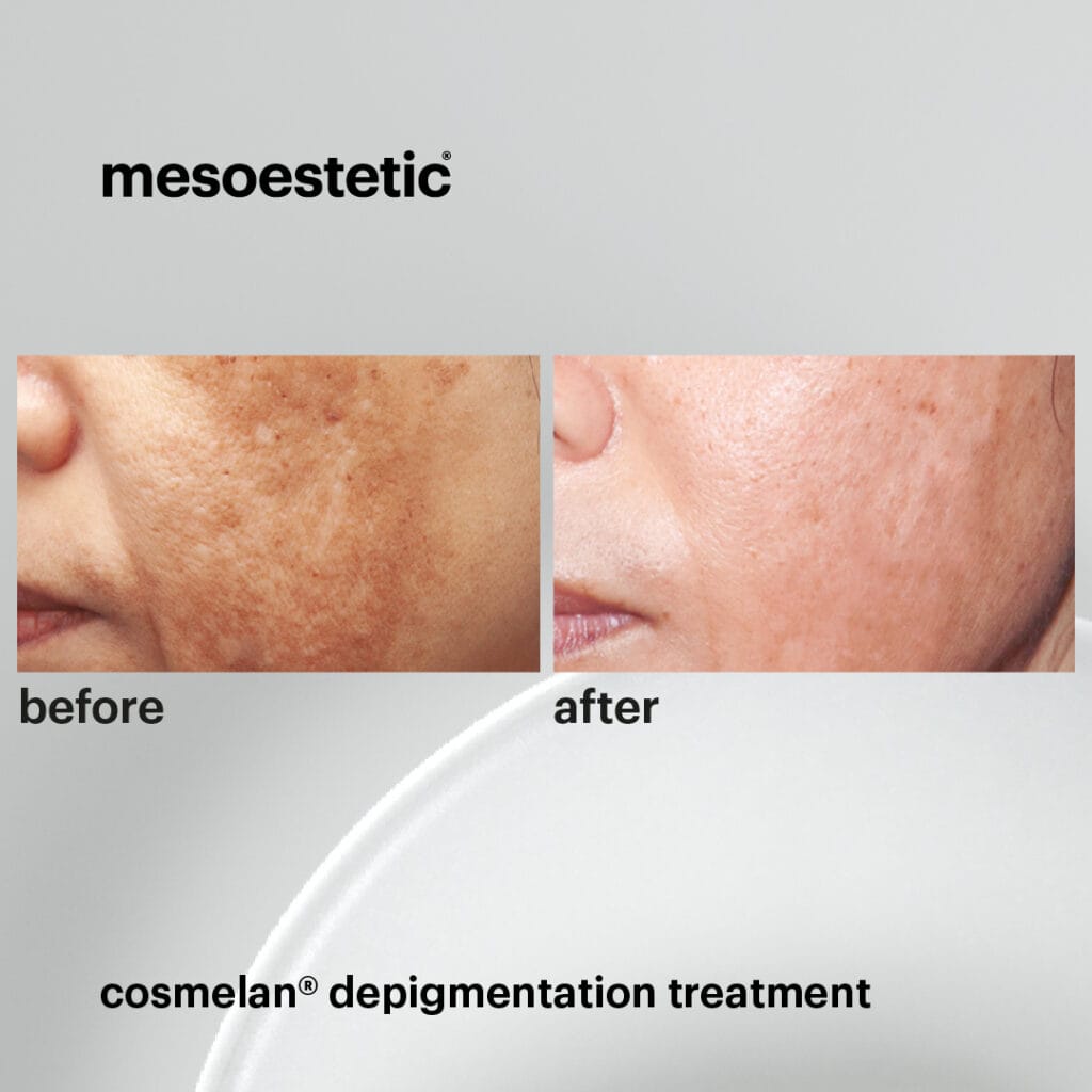 professional depigmenting treatment