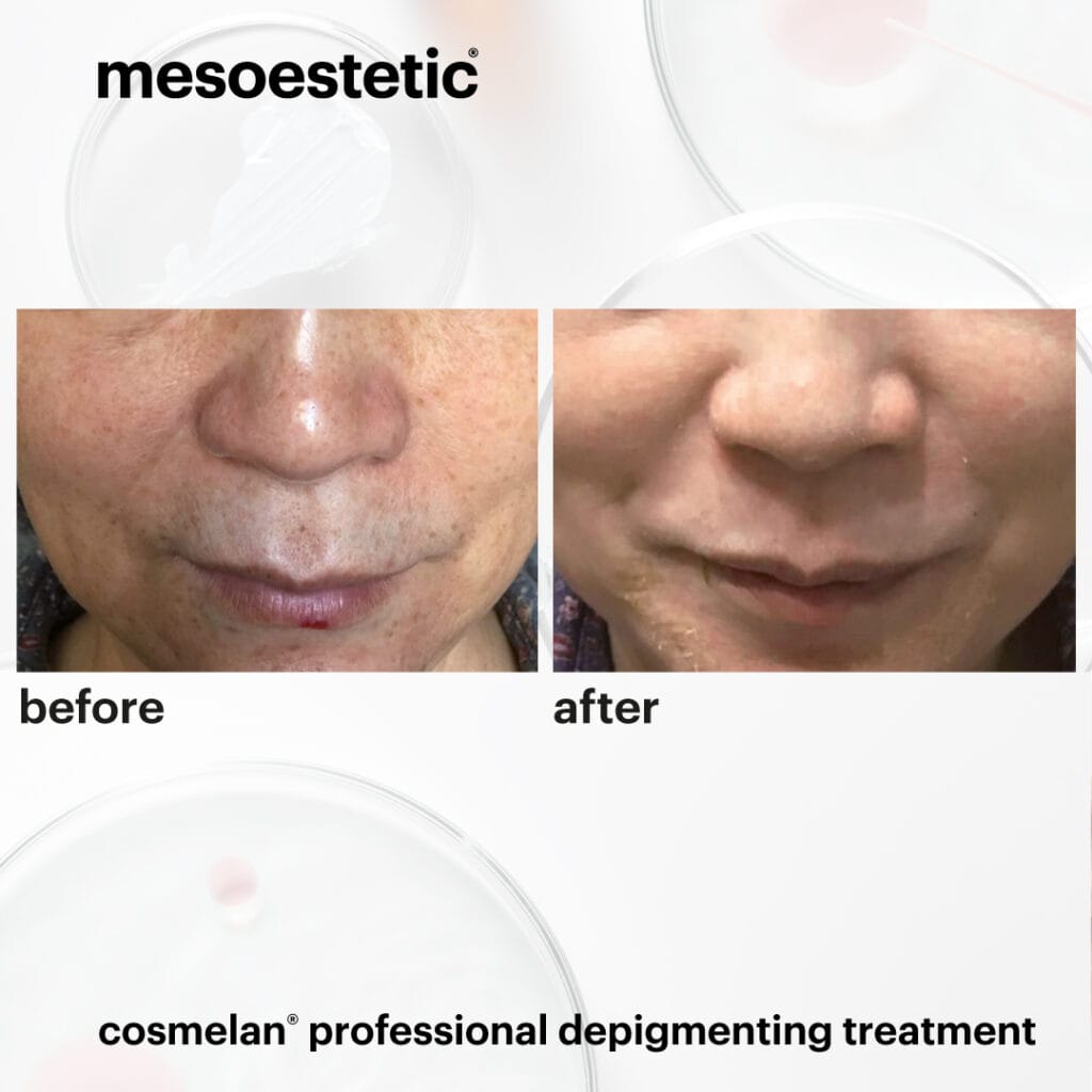 professional depigmenting treatment