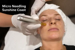 Micro Needling Sunshine Coast